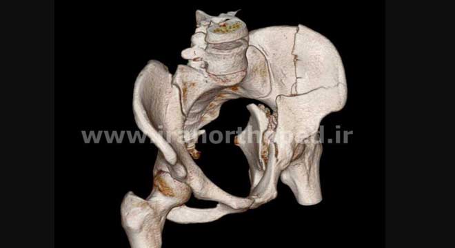 نمونه های جراحی شکستگی های دوستونی استابولوم. بررسی تخصصی 30 شکستگی دو ستونی استابولوم