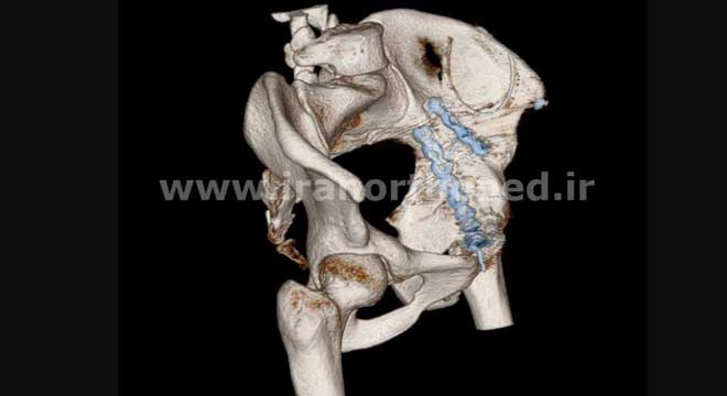 نمونه های جراحی شکستگی های دوستونی استابولوم. بررسی تخصصی 66 شکستگی دو ستونی استابولوم. نمونه دوم