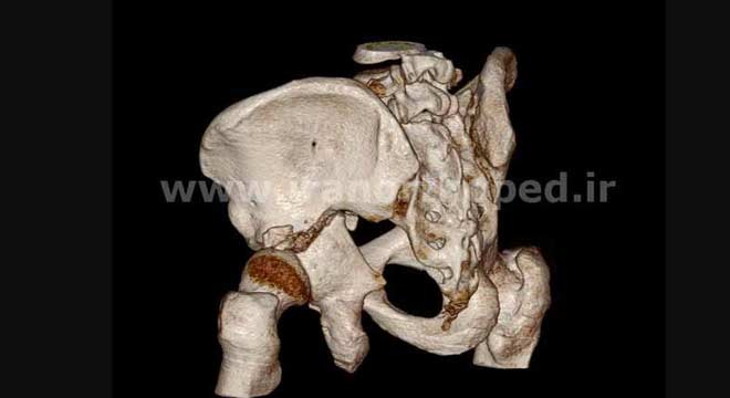 شکستگی ستون خلفی و لب خلفی استابولوم