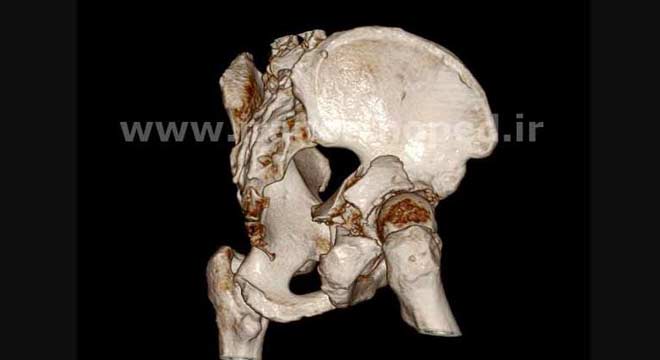 شکستگی ستون و لب خلفی استابولوم