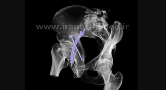 شکستگی عرضی استابولوم