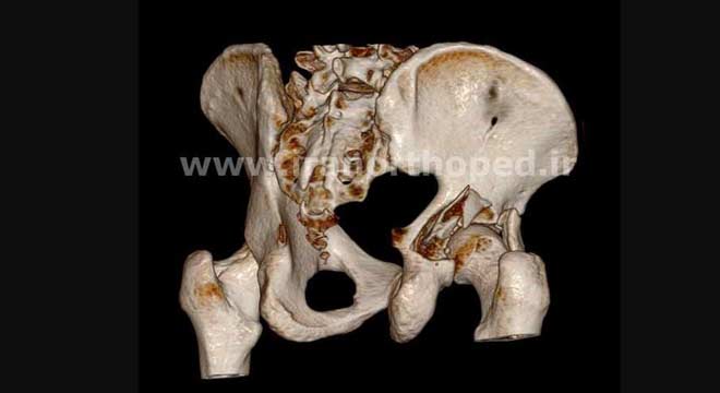  شکستگی لبه خلفی استابولوم