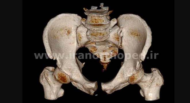  دررفتگی سمفیز پوبیس