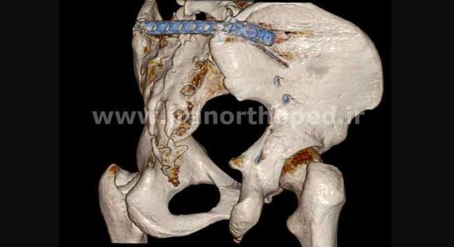 شکستگی ساکروم و استابولوم