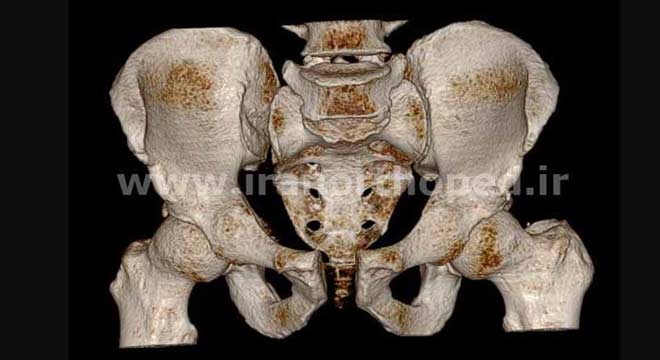 دیاستاز سمفیز پوبیس و در رفتگی مفصل ساکروایلیاک