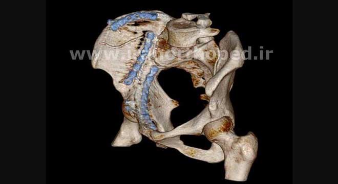 نمونه های جراحی شکستگی های دوستونی استابولوم. بررسی تخصصی 101 شکستگی دو ستونی استابولوم