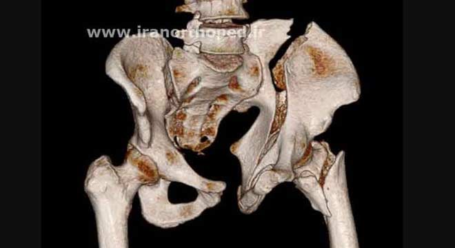 شكستگی ایلیوم و دررفتگی مفصل ساكروایلیاك