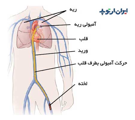 آمبولی ریوی