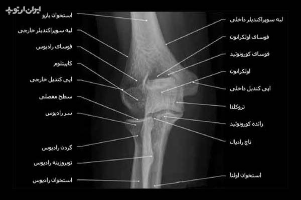 رادیوگرافی رخ آرنج