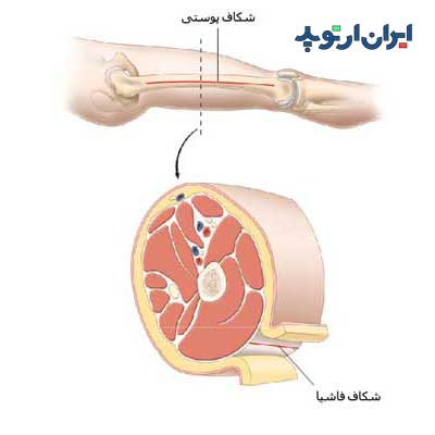 جراحی سندروم کمپارتمان