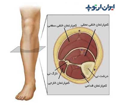 سندروم کمپارتمان