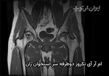 عکس سیاه شدن استخوان لگن در ام آر آی