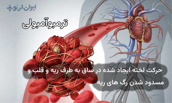 علت ورم ساق و لخته بعد از تعویض مفصل ران 3 ترومبوآمبولی به معنای حرکت لخته ایجاد شده در ساق به سمت ریه و قلب و انسداد عروق ریوی است