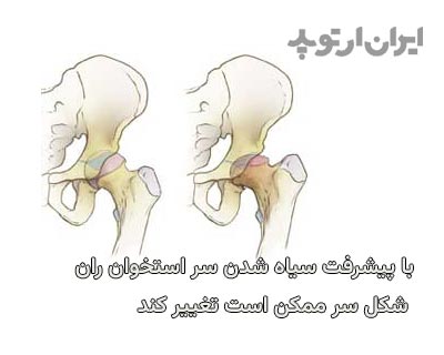  تغییر شکل سر استخوان ران بدنبال نکروز و سیاه شدن استخوان لگن