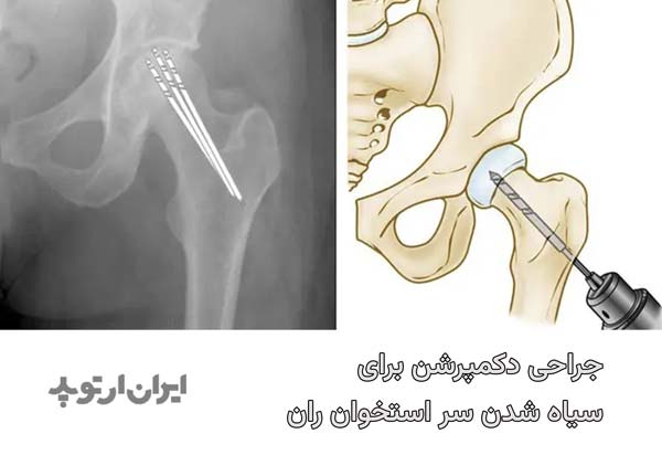 جراحی دکمپرشن برای درمان سیاه شدن لگن