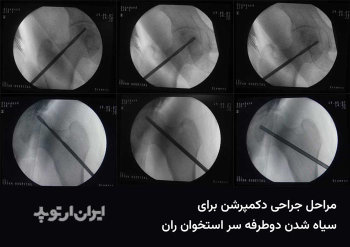 درمان سیاه شدن لگن. سوراخ کردن سر استخوان ران چپ و راست در چند ناحیه – تصاویر فوق از مانیتور دستگاه سی آرم و در حین عمل جراحی تهیه شده اند