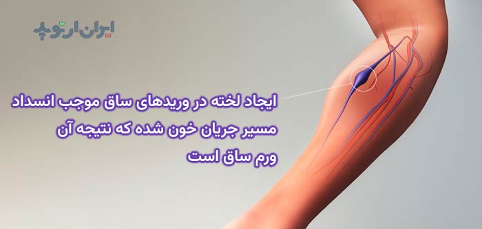 علت ورم ساق و لخته بعد از تعویض مفصل ران 2 ایجاد لخته در وریدهای ساق موجب انسداد مسیر جریان خون شده که نتیجه آن ورم ساق است