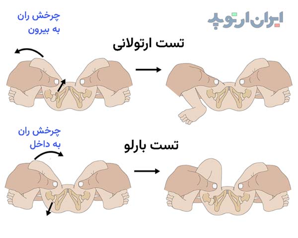 عکس دررفتگی لگن نوزاد. تست ارتولانی و بارلو برای تشخیص دررفتگی مادرزادی لگن و مفصل ران در نوزادان