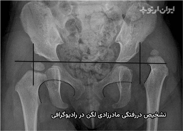 عکس دررفتگی لگن نوزاد. کمک رادیوگرافی به تشخیص دررفتگی مادرزادی لگن