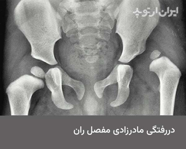  عکس دررفتگی لگن نوزاد. سر کروی شکل استخوان ران در داخل حفره استابولوم قرار ندارد