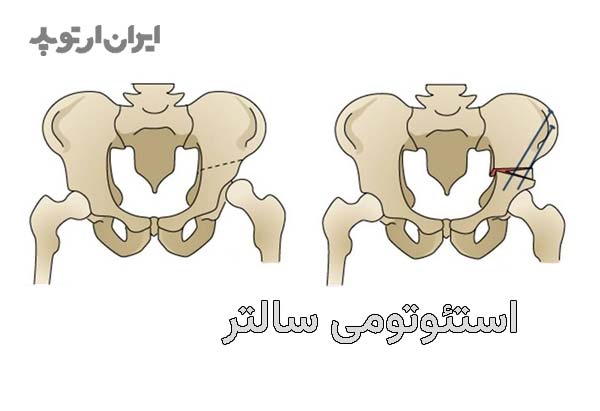  عمل جراحی دررفتگی لگن مادرزادی. استئوتومی استخوان لگن برای تغییر زوایای استابولوم و کمک به جااندازی مفصل ران