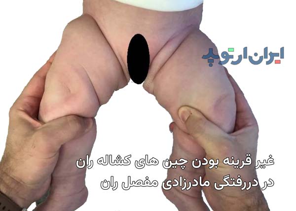 عکس دررفتگی لگن نوزاد. چین های کشاله ران غیر قرینه از علائم دررفتگی مادرزادی لگن است
