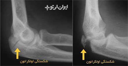 شکستگی آرنج بالغین. انواع و درمان 8 شکستگی آرنج در ناحیه اولکرانون