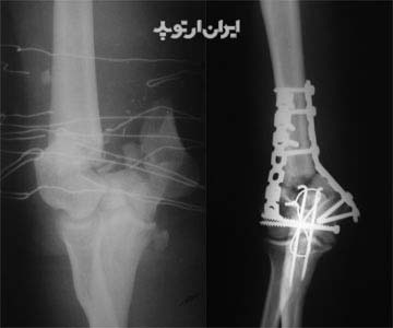 شکستگی آرنج بالغین. انواع و درمان 2 درمان جراحی شکستگی آرنج در ناحیه سوپراکندیلر