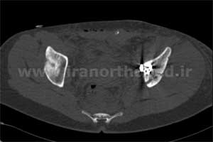 نمونه های جراحی شکستگی های دوستونی استابولوم. بررسی تخصصی 58 شکستگی دو ستونی استابولوم لگن