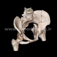 نمونه های جراحی شکستگی های دوستونی استابولوم. بررسی تخصصی 52 شکستگی دو ستونی استابولوم لگن