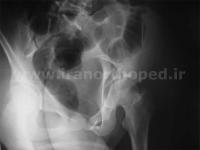 نمونه های جراحی شکستگی های دوستونی استابولوم. بررسی تخصصی 33 شکستگی دو ستونی استابولوم لگن