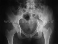 نمونه های جراحی شکستگی های دوستونی استابولوم. بررسی تخصصی 31 شکستگی دو ستونی استابولوم لگن