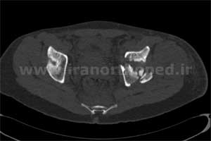 نمونه های جراحی شکستگی های دوستونی استابولوم. بررسی تخصصی 45 شکستگی دو ستونی استابولوم لگن