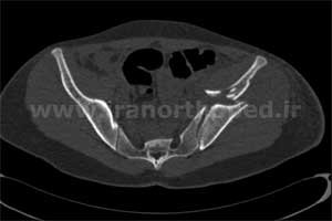 نمونه های جراحی شکستگی های دوستونی استابولوم. بررسی تخصصی 38 شکستگی دو ستونی استابولوم لگن