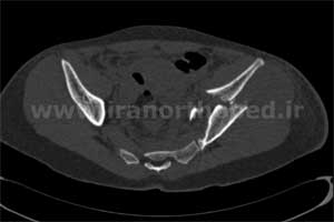 نمونه های جراحی شکستگی های دوستونی استابولوم. بررسی تخصصی 39 شکستگی دو ستونی استابولوم لگن