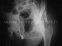 نمونه های جراحی شکستگی های دوستونی استابولوم. بررسی تخصصی 32 شکستگی دو ستونی استابولوم لگن