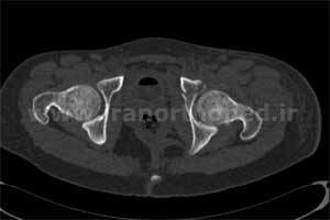 نمونه های جراحی شکستگی های دوستونی استابولوم. بررسی تخصصی 48 شکستگی دو ستونی استابولوم لگن