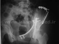 نمونه های جراحی شکستگی های دوستونی استابولوم. بررسی تخصصی 55 شکستگی دو ستونی استابولوم لگن