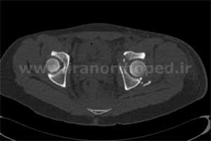 نمونه های جراحی شکستگی های دوستونی استابولوم. بررسی تخصصی 47 شکستگی دو ستونی استابولوم لگن