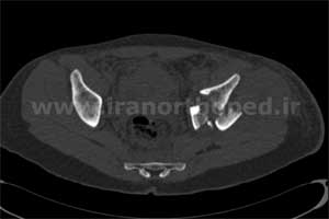 نمونه های جراحی شکستگی های دوستونی استابولوم. بررسی تخصصی 42 شکستگی دو ستونی استابولوم لگن