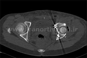 نمونه های جراحی شکستگی های دوستونی استابولوم. بررسی تخصصی 60 شکستگی دو ستونی استابولوم لگن