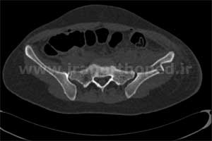 نمونه های جراحی شکستگی های دوستونی استابولوم. بررسی تخصصی 34 شکستگی دو ستونی استابولوم لگن