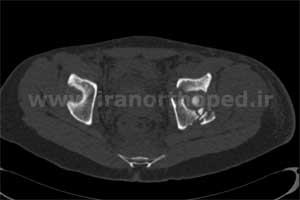 نمونه های جراحی شکستگی های دوستونی استابولوم. بررسی تخصصی 46 شکستگی دو ستونی استابولوم لگن