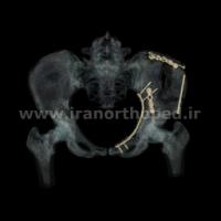 نمونه های جراحی شکستگی های دوستونی استابولوم. بررسی تخصصی 64 شکستگی دو ستونی استابولوم لگن