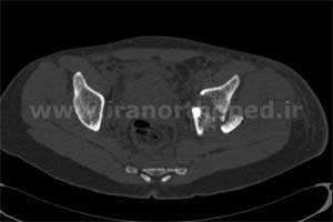 نمونه های جراحی شکستگی های دوستونی استابولوم. بررسی تخصصی 43 شکستگی دو ستونی استابولوم لگن