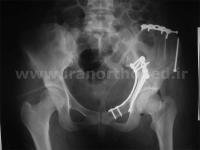 نمونه های جراحی شکستگی های دوستونی استابولوم. بررسی تخصصی 53 شکستگی دو ستونی استابولوم لگن