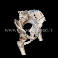نمونه های جراحی شکستگی های دوستونی استابولوم. بررسی تخصصی 63 شکستگی دو ستونی استابولوم لگن