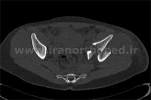 نمونه های جراحی شکستگی های دوستونی استابولوم. بررسی تخصصی 41 شکستگی دو ستونی استابولوم لگن