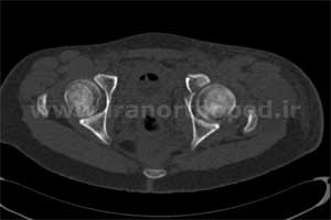 نمونه های جراحی شکستگی های دوستونی استابولوم. بررسی تخصصی 49 شکستگی دو ستونی استابولوم لگن