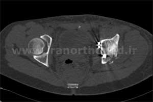 نمونه های جراحی شکستگی های دوستونی استابولوم. بررسی تخصصی 59 شکستگی دو ستونی استابولوم لگن